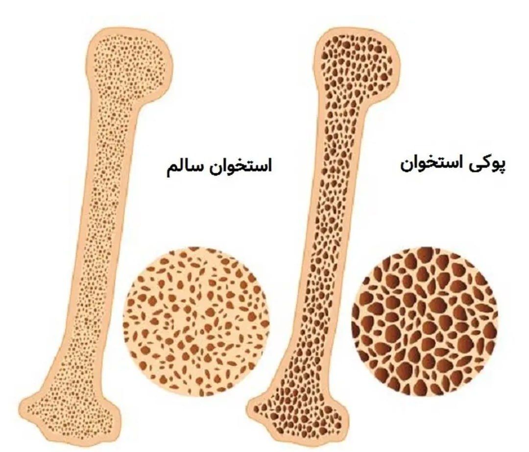 چگونه استخوان‌هایمان پوک می‌شوند